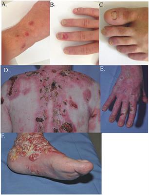 junctional epidermolysis bullosa List of Frontiers open access